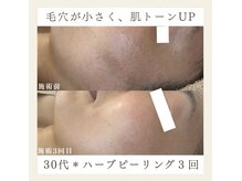 サロンドペシェ(salon de peche)/30代＊ハーブピーリング３回