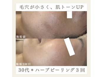 サロンドペシェ(salon de peche)/30代*ハーブピーリング3回