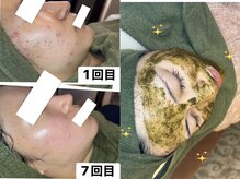 ソルカナ(Solkana)の雰囲気（【お得な回数券◎】ハーブピーリング/毛穴洗浄で肌質改善）
