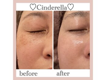 シンデレラ しみケア(Cinderella)/シミケアプログラム