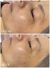 リノベル(LINOBELLE)/ハーブピーリングで変わります！