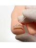 【巻き爪・肥厚爪】まずは無料カウンセリングでご相談ください