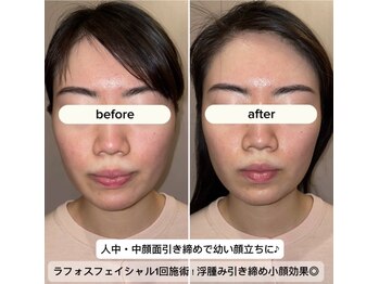 久遠(kuon)/ラフォス小顔リフト♪