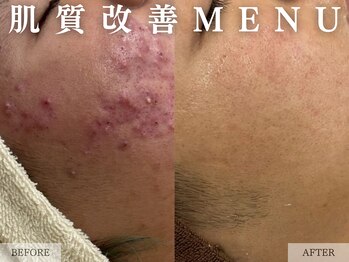 レヴェリー 心斎橋店(REVERIE)/‐ ハーブピーリングの経過 ‐