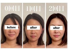 キプラ 福津店(KIPURA)の雰囲気（小顔矯正でみるみる綺麗になって行くお客様です♪別人級？♪）