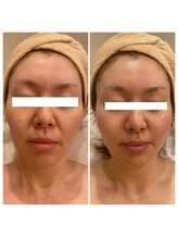 ルヴィアン 流山おおたかの森店(LUVIAN)/乾燥毛穴がふっくらし目立たなく