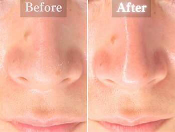 ボーンオム(Born Homme)/毛穴洗浄+美容液導入:30代女性