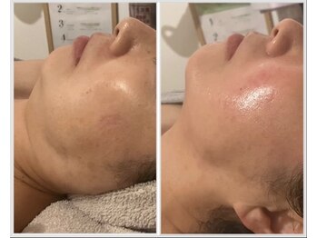 美しぐれ 溝の口店/【1回】LDM/インモード/LED