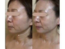 リフテグレース(LIFTE Grace)/光×テラボーラー初回