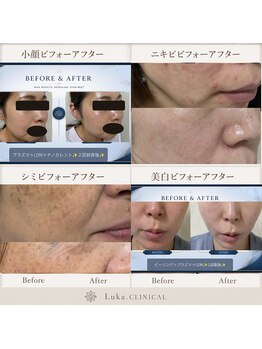 ルカクリニカル(Luka.CLINICAL)の写真/毛穴改善、シミ、ニキビ、小顔に最先端韓国式LDMやプラズマ、IPLフォト美容のプロが提案するツルツル肌へ♪