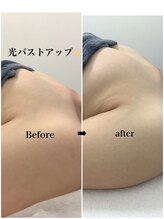 メディカルサロンドオフ 堺東店(medical salon de off)/光バストアップメニュー♪前後