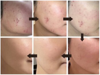 アイル 博多祇園店(iru)/ハーブピーリングでニキビケア！