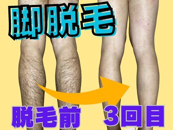 柏ベルミーランド/来夏に間に合う脚脱毛◎