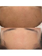 サロン ド ハニー(Salon de Honey)/剥けないハーブピーリング