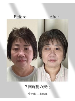 トータルトリートメント優鍼灸院/７回施術の効果