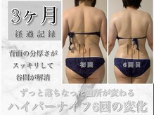 ビナル(BeNAL)/痩身☆ハイパーナイフB/A