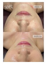 ミュアン(La Mueien)/たるみ/シワ/ほうれい線/毛穴