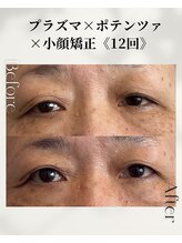 ドゥシール(Docile)/60代女性｜瞼たるみ・二重改善