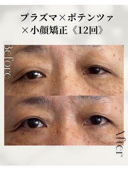 ドゥシール(Docile)/60代女性｜瞼たるみ・二重改善