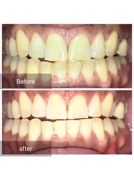 メンズ脱毛 リボーン(reborn)/ホワイトニング一度の変化