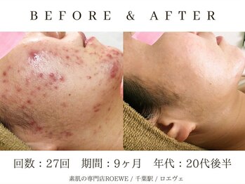 ロエヴェ(ROEWE)/ニキビ改善・毛穴ケア・肌質改善