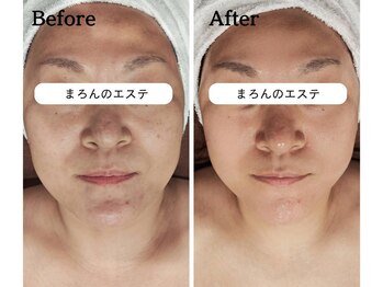まろんのエステ/40代 小顔コルギ