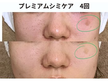 プレジール(plaisir)/シミケアコース