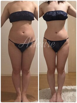 エルール トータルビューティ(Aileure total beauty)/インディバ,アミノ酸,燃焼ジェル