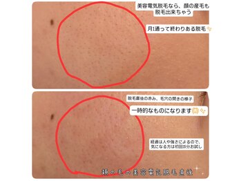 ベビースキン(baby skin)/美容電気脱毛