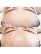 エミュ(emu)/waxでゆで卵肌！