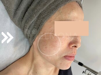 グリーンピール エルモナ(GREENPEEL ELMONA)/【グリーンピールレスベラ】