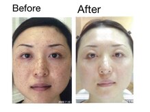 ジェニックサロン グランドギンザ ひたちなか(GENIC SALON GRAND GINZA)/全国肌改善コンテスト受賞症例