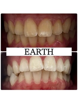アース(EARTH)/【ビフォーアフター】美白