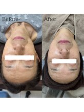 ラ フルール(La Fleur)/エアバリ フェイシャルエステ