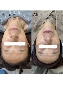 ラ フルール(La Fleur)/エアバリ フェイシャルエステ