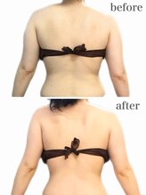 リリィブラン(Lily branc)/ブライダル痩身/上半身痩身