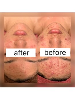 グラナーダ(granada)/ハーブトリートメント