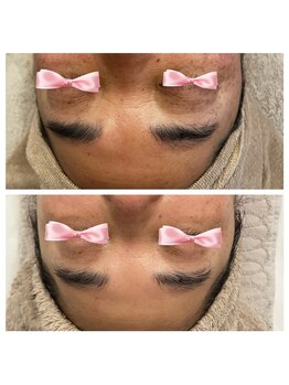 美温(mion)/白玉ピーリング×レッドショット