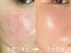 アルカンシエル(arcenciel)の写真/ニキビだけじゃない。毛穴・ざらつきまで整える肌質改善