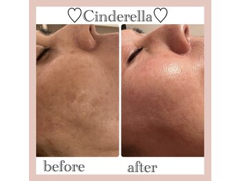 シンデレラ しみケア(Cinderella)/シミケアプログラム