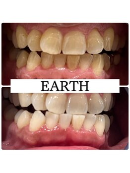 アース(EARTH)/【ビフォーアフター】美白