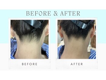 シャンディール(shandeel)/襟足脱毛