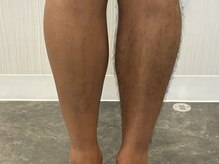 ハーレ(HA-RE)/脚脱毛3回完了！日焼け肌OK！