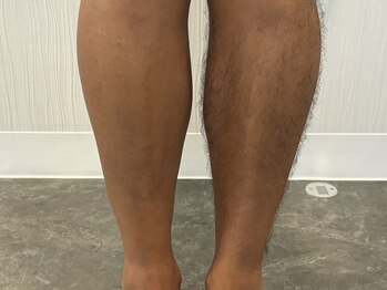 ハーレ(HA-RE)/脚脱毛3回完了！日焼け肌OK！