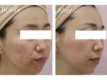 スマートポッシュ(Smart posh)/【ニキビケア】before→after