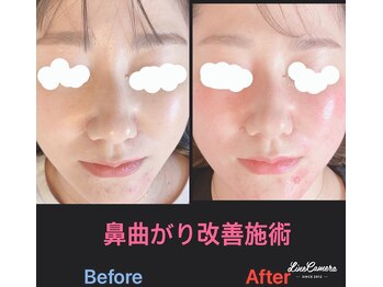 美容矯正サロン レレポノ(LELEPONO)/鼻の曲がり改善