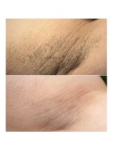 アモリアージュ(Amolliage)/パワー美肌脱毛・わき