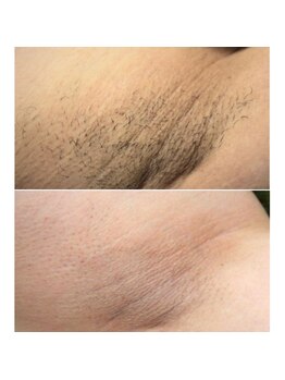 アモリアージュ(Amolliage)/パワー美肌脱毛・わき