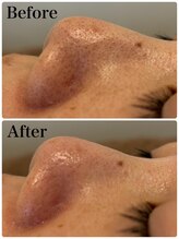 モテ 新宿店(Mote)/ハイドラ毛穴洗浄＋艶肌Wax 新宿