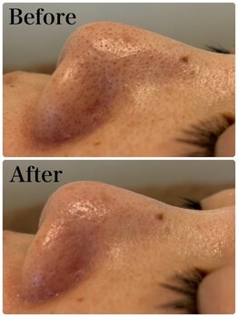 モテ 新宿店(Mote)/ハイドラ毛穴洗浄＋艶肌Wax 新宿